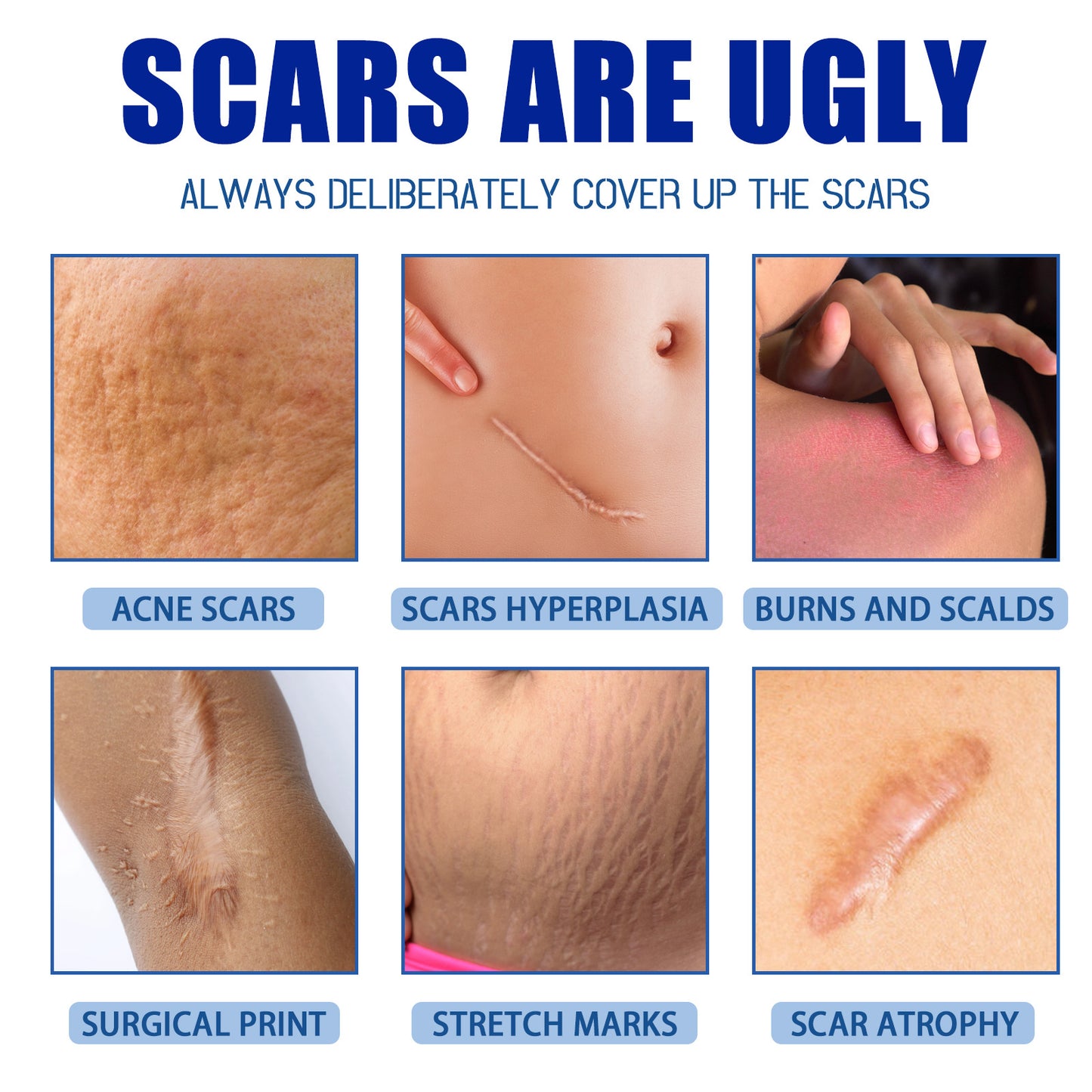 Scar wart Removal Cream